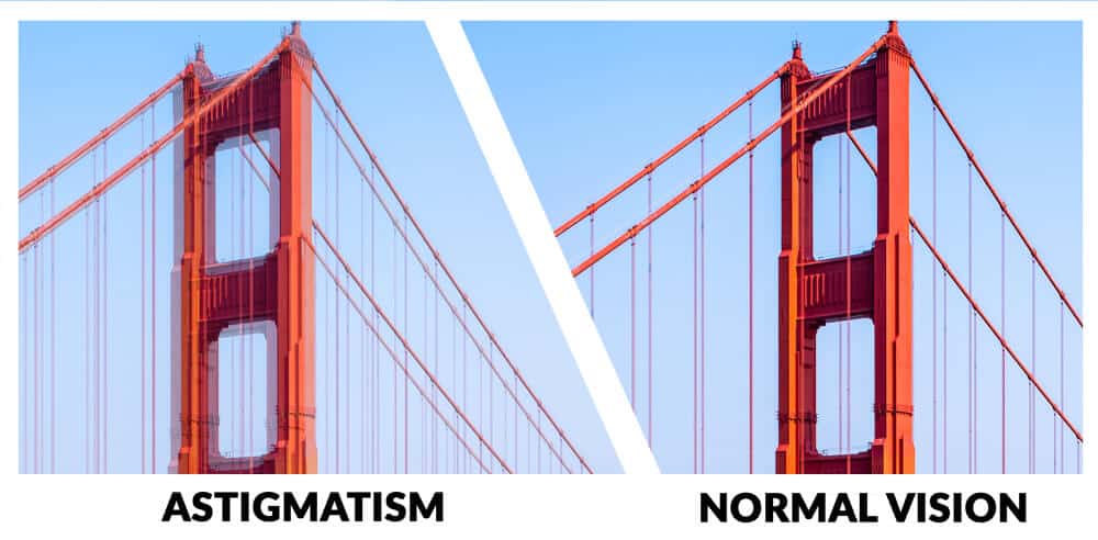 Example of vision with Astigmatism. It is a type of refractive error in which the eye does not focus light evenly on the retina. This results in distorted or blurred vision at all distances