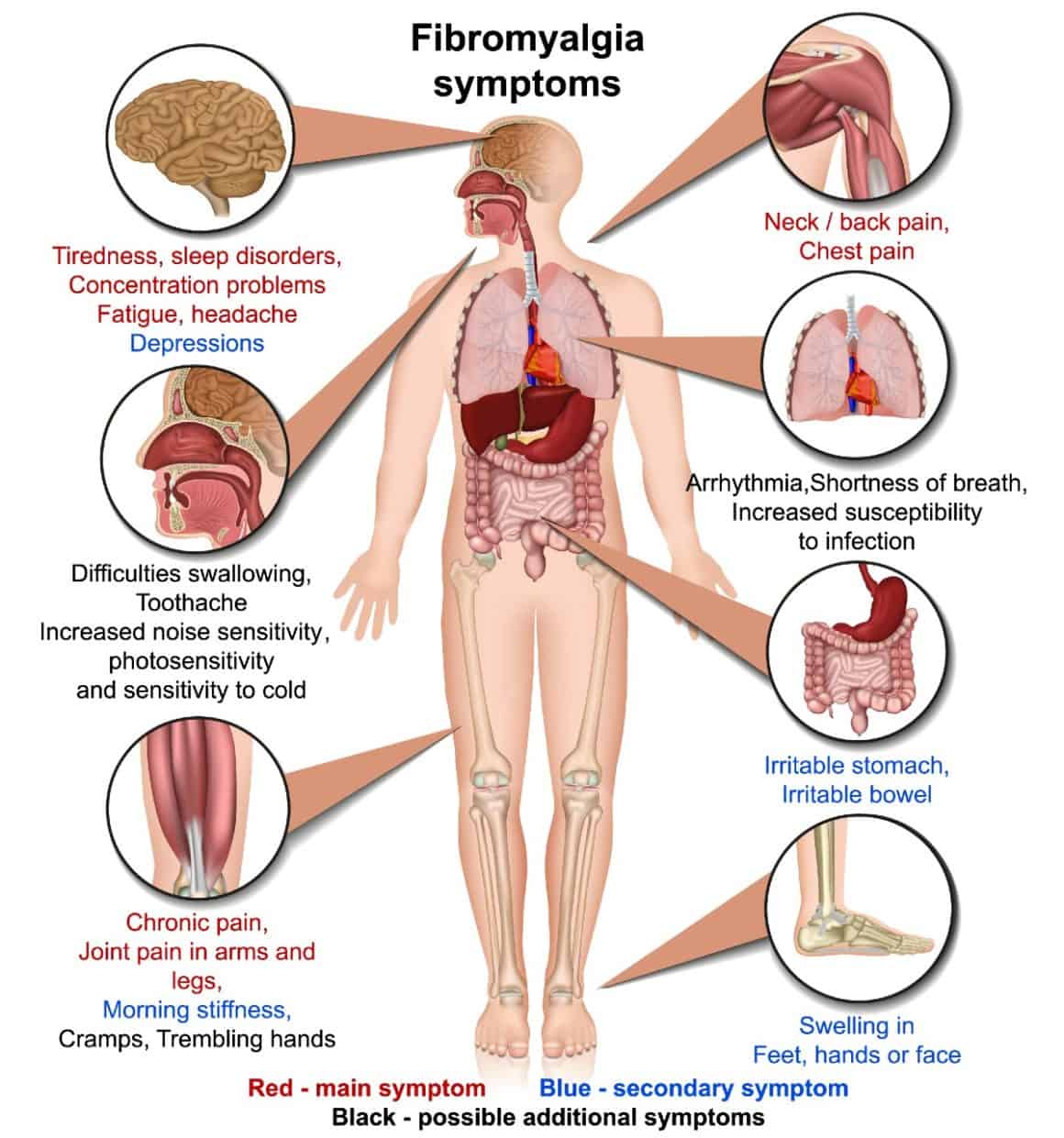 visual representation of fibromyalgia