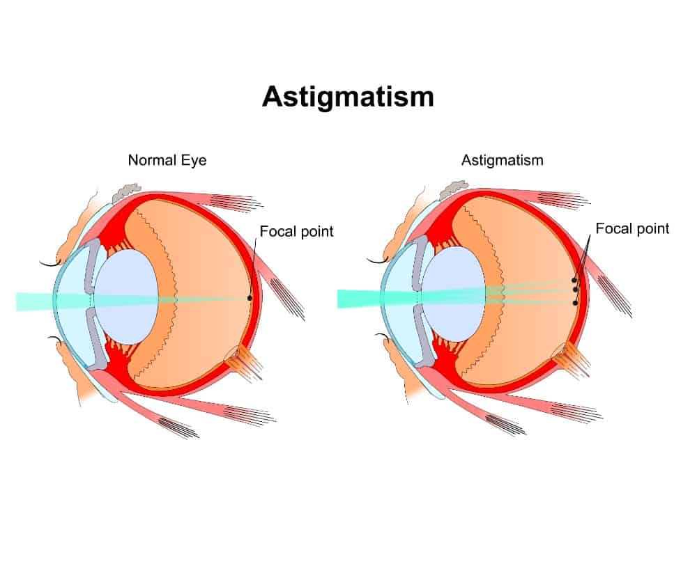 Astigmatism. Eye vision disorder.Diagram of the eye