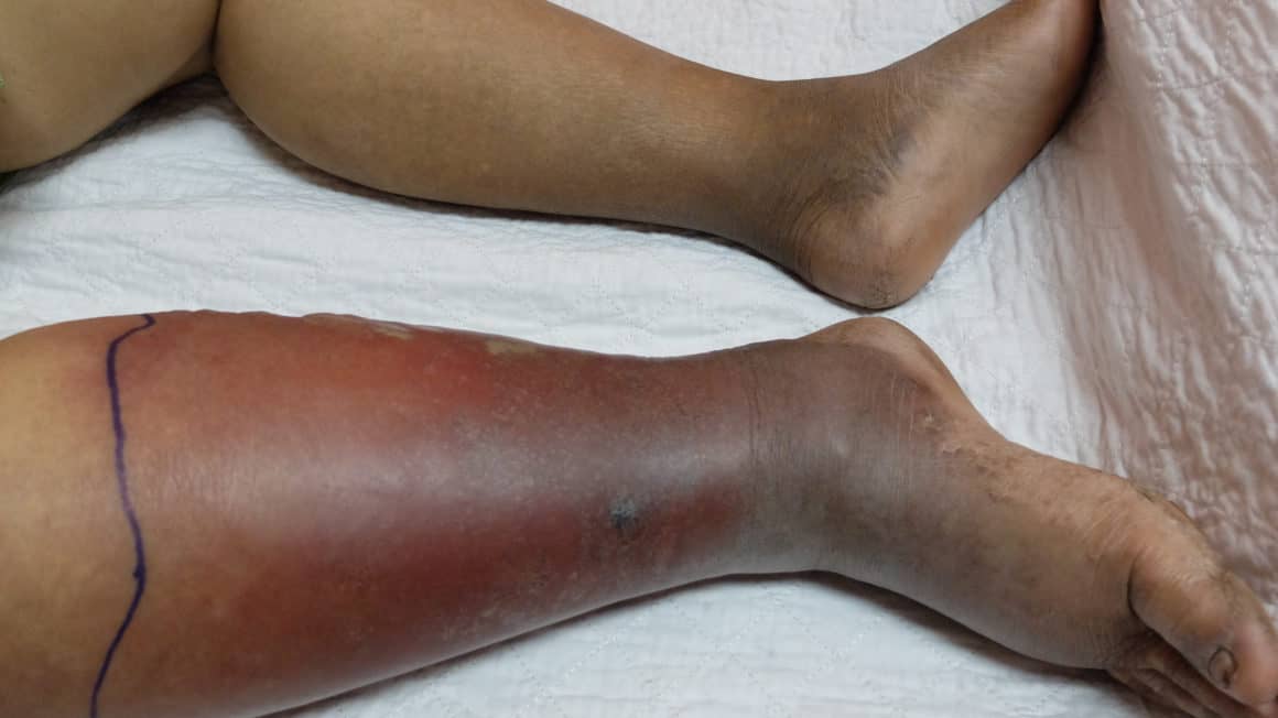 Cellulitis of Right lower limb.