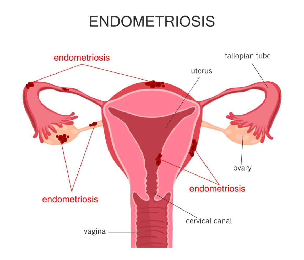 Endometriosis diagram. Diseases of the female reproductive system. Vector illustration.