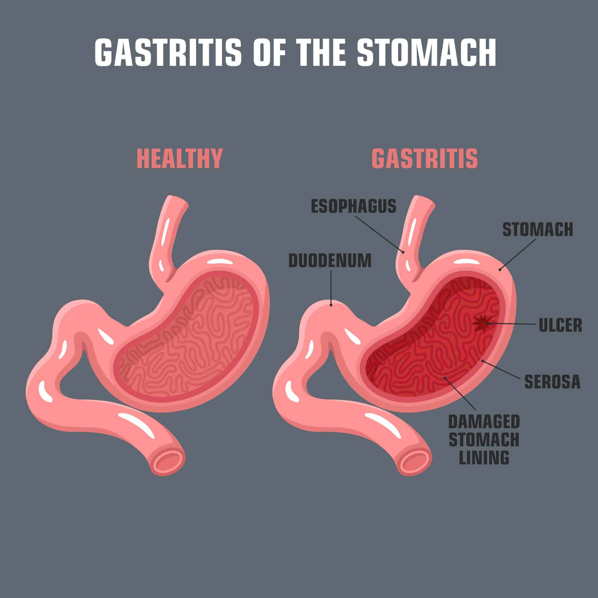 Gastritis Drug Genius