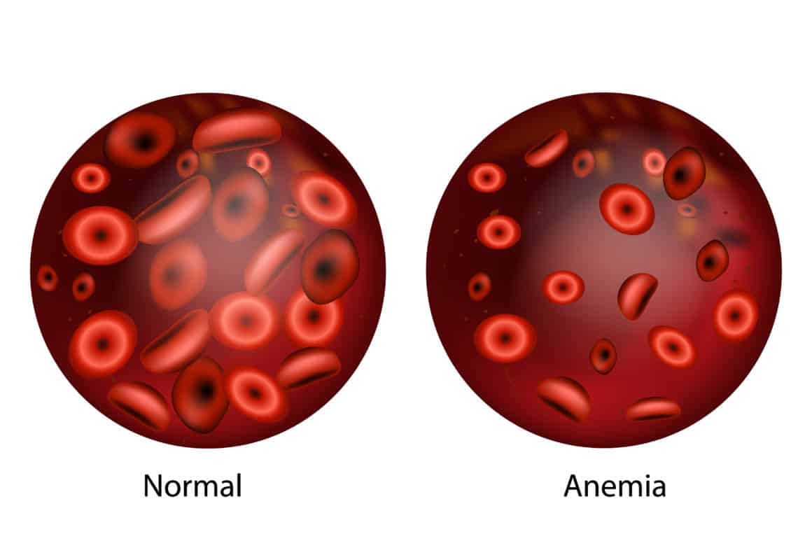 Anemia De Fanconi Expectativa De Vida - BRAINCP