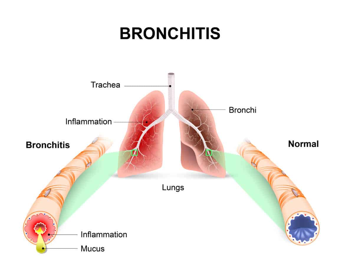 Bronchitis. Lungs and bronchial tubes. normal bronchial tube and a bronchial tube with bronchitis.