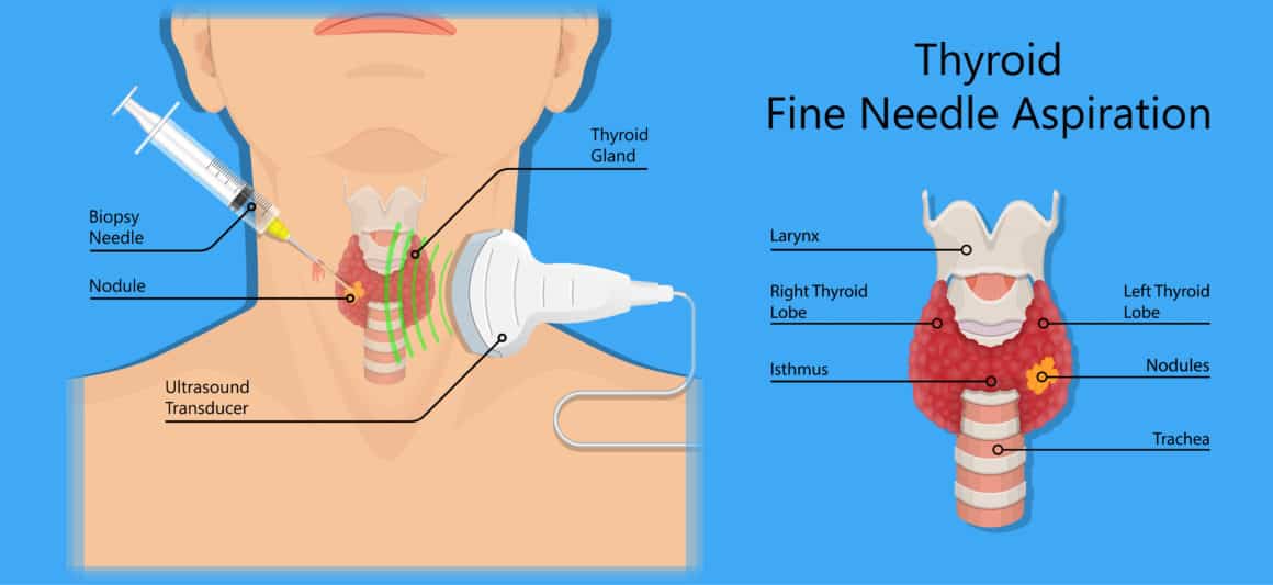 Thyroid cancer disease nodules ultrasound screening check medical treat fine needle aspiration lumps test lab gland neck pain Graves FNA FNAB Large Toxic diagnostic exam collect lymph nodes cell