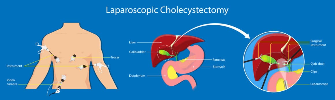 Gallstones cholecystectomy gallbladder removal surgery