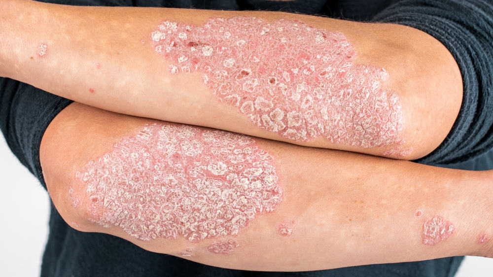 Medical Description Of Psoriasis Rash At Wendy Richey Blog