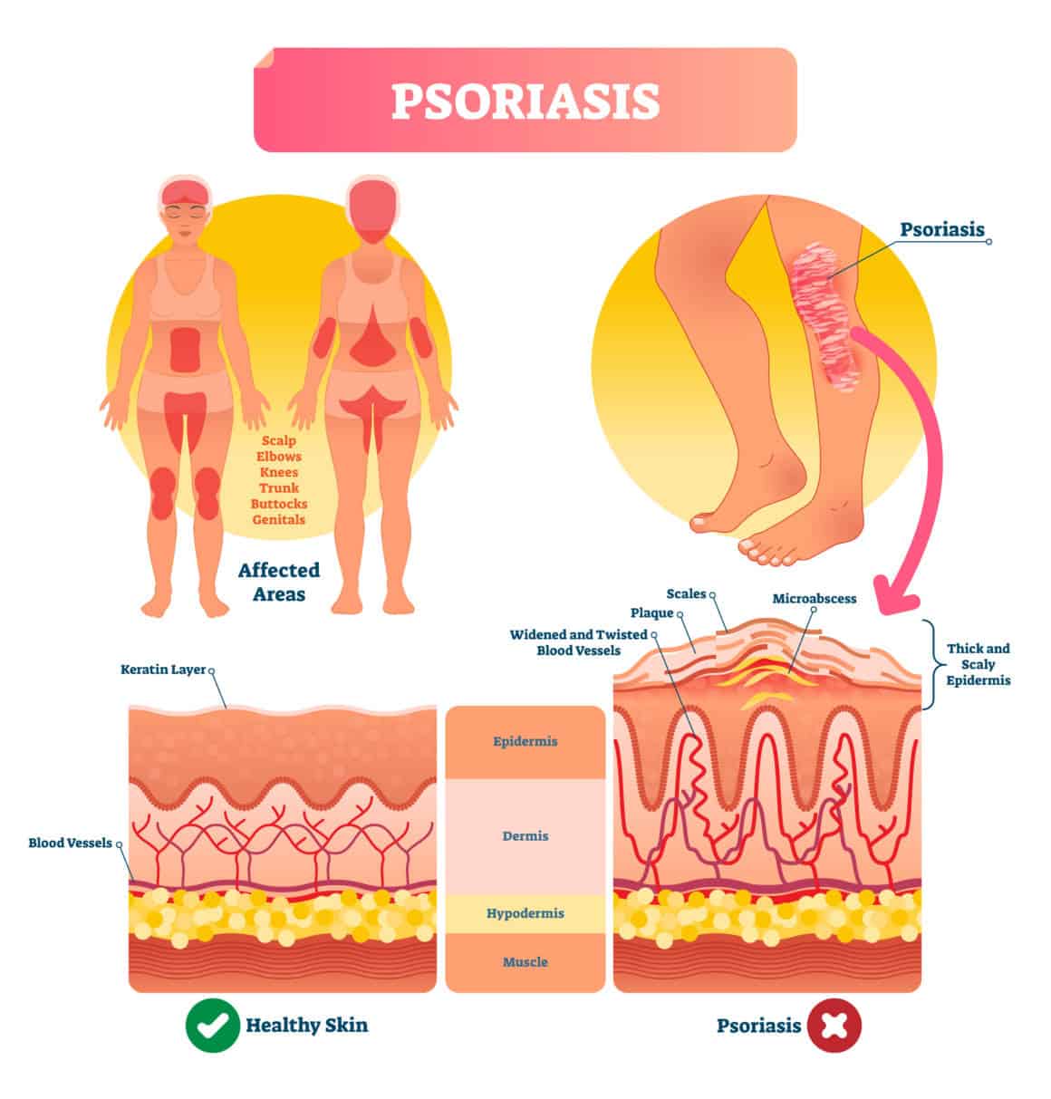 psoriasis-subcutaneous-diagram