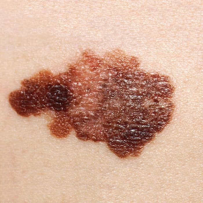 This photograph, produced by the Skin Cancer Foundation, and made available by the National Cancer Institute (NCI), depicts a close view of a dermatology patient’s skin surface, revealing the presence of brown pigmented lesion, which was diagnosed as melanoma. This lesion exhibited a heterogeneous, mottled pigmentation, ranging from light tan, to dark brown, and is very asymmetrical, with a highly irregular border. All these characteristics should raise the suspicions of a qualified dermatologist, as to the melanomatous nature of this lesion. Use of this image requires acknowledgement that NCI is the image source, as well as the inclusion of the website, www.cancer.gov.
