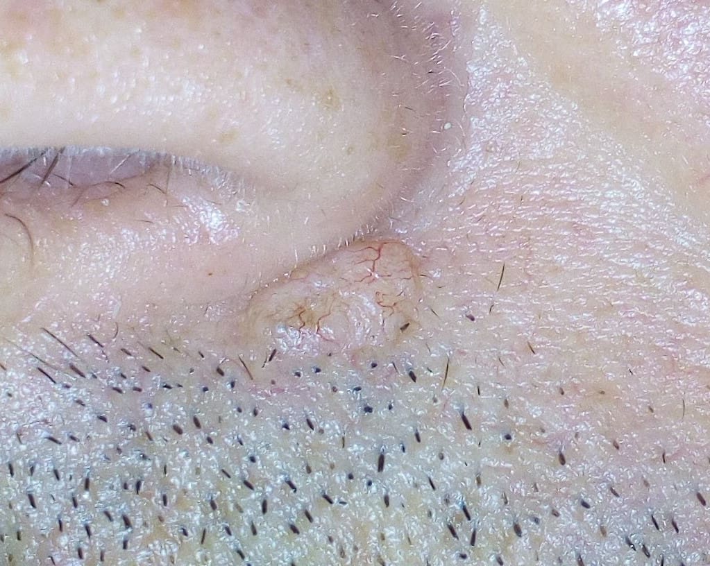 Basal cell carcinoma under the nose of a pale-skinned man