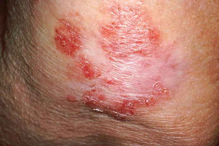 This photograph, made available by the Dermatology Branch of the National Cancer Institute (NCI), depicts a close view of a dermatology patient’s skin, revealing the presence of a flat, mottled red spot that was rough, dry, and scaly. These characteristics warranted further scrutiny by a qualified dermatologist, in order to make a determination, as to whether this lesion was precancerous, or had evolved into a frank form of skin cancer. Use of this image requires acknowledgement that NCI is the image source, as well as the inclusion of the website, www.cancer.gov.