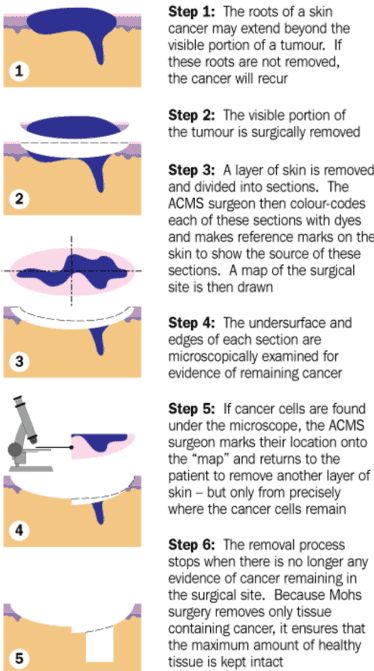 Excision of ellipse of skin containing a tumour, with microscopic examination of tumour margins using the Mohs technique