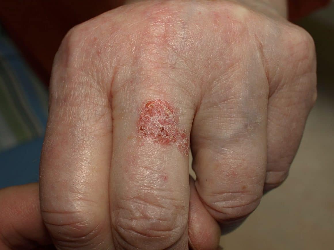 Bowen disease in 81-year-old pale woman; appears as a scaly red patch that resembles eczema.