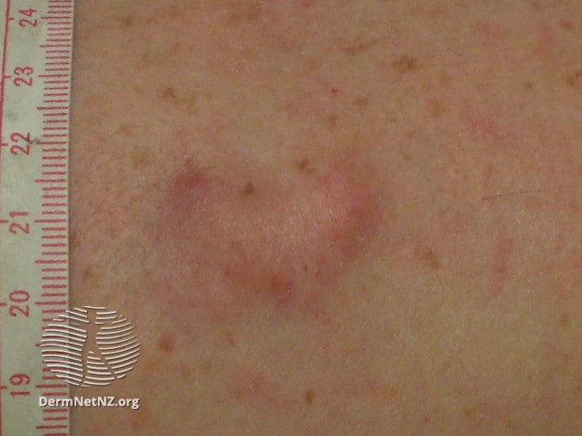 Dermatofibrosarcoma protuberans (DFSP) is another rare form of skin cancer. Example of this type of tumor on the skin of a pale person next to measuring tape.