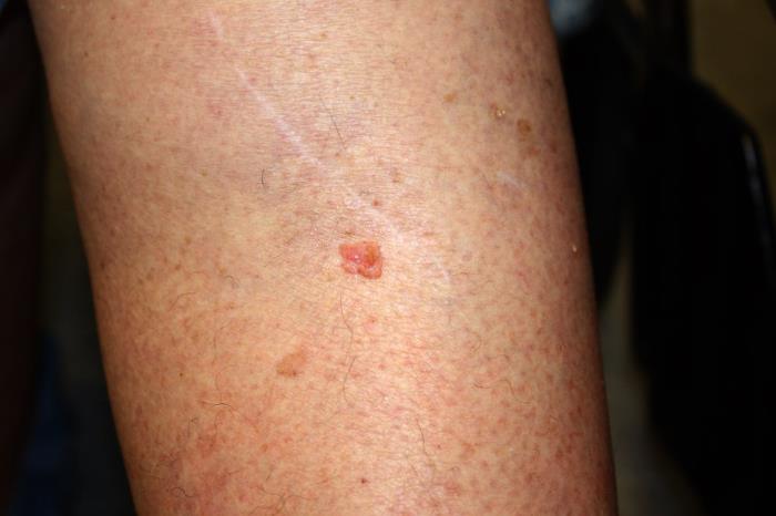 This photograph, created by Kelly Nelson, and made available by the National Cancer Institute (NCI), depicts a close view of the skin of a dermatology patient's lower leg, revealing the presence of an asymmetrical, raised red lesion, which was determined to be a case of skin cancer known as squamous cell carcinoma. Use of this image requires acknowledgement that NCI is the image source, as well as the inclusion of the website, www.cancer.gov.