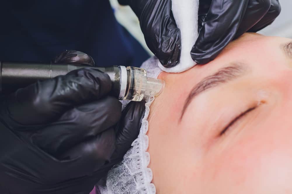 Dermabrasion girl's forehead. Instrumental cosmetology. Spa. Facial Rejuvenation. Mechanical peeling skin.