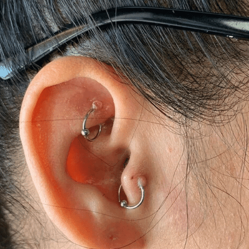 Piercing bump vs. keloid: How to tell the difference and what to do