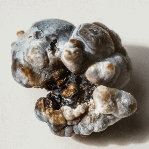 Kidney Stone