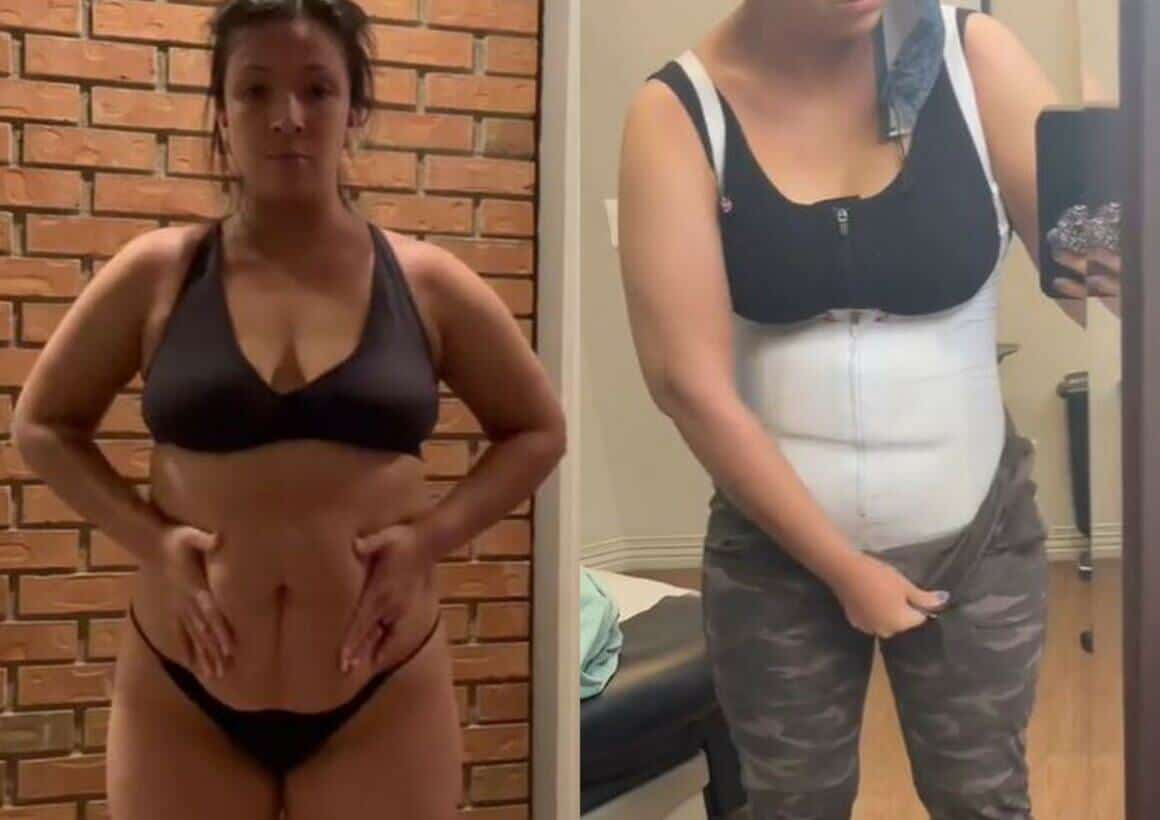 Tummy Tuck Before And After