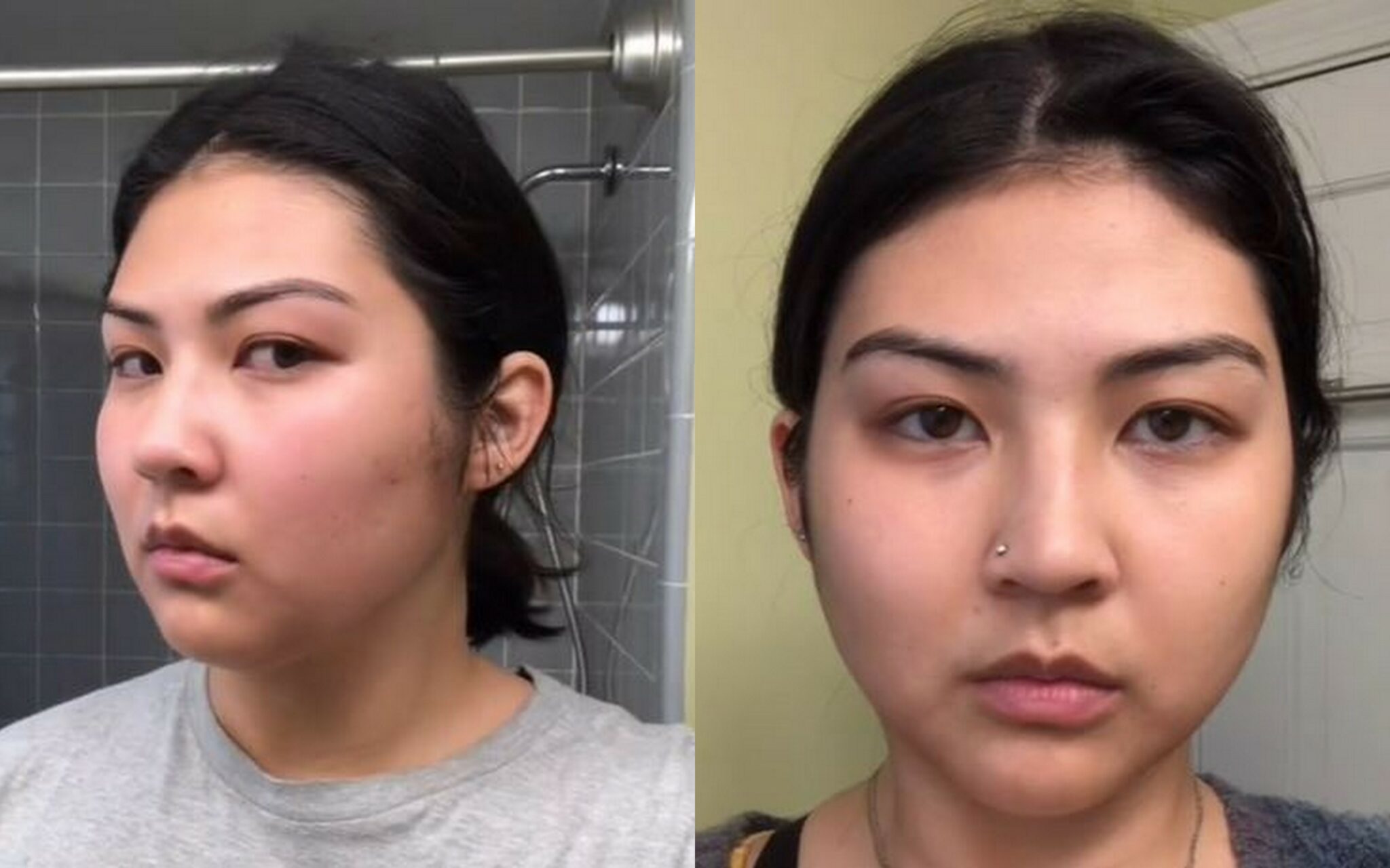 Gua Sha Before And After Pictures & Videos - Drug Genius