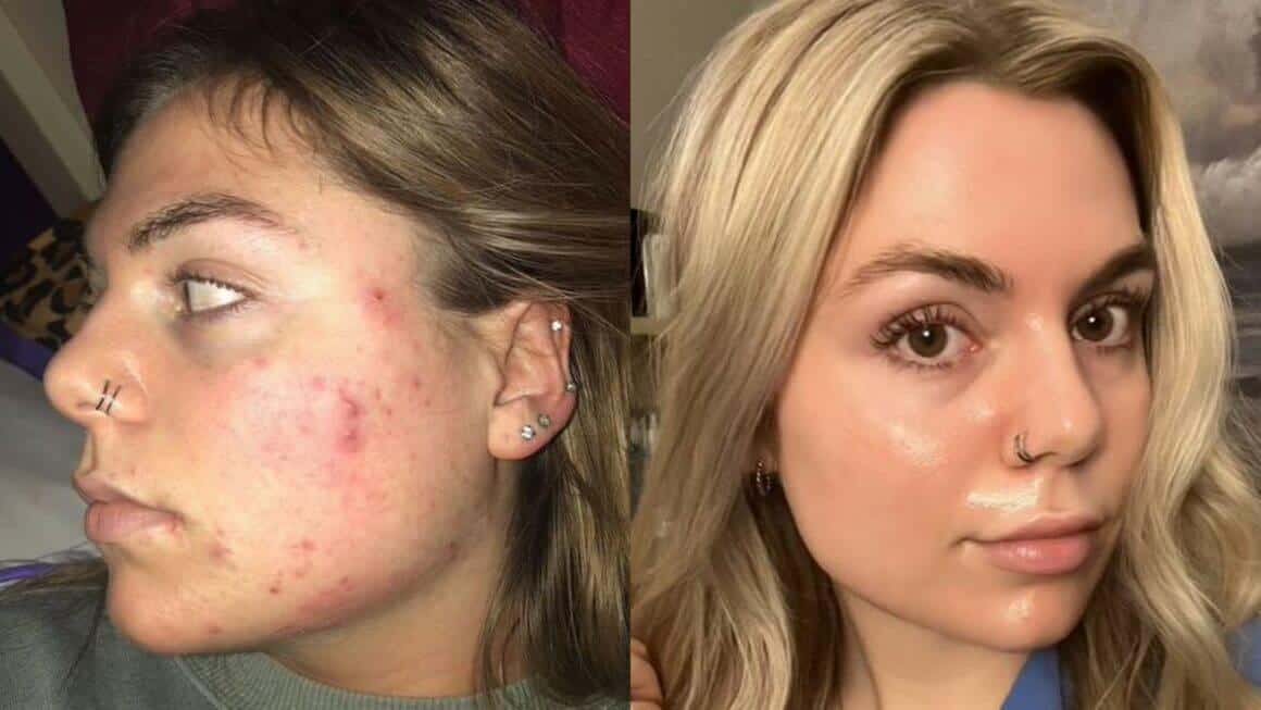 tretinoin before and after wrinkles