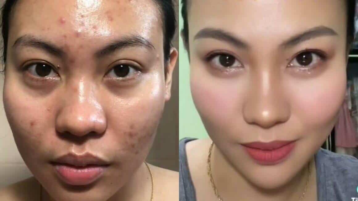 tretinoin cream before and after