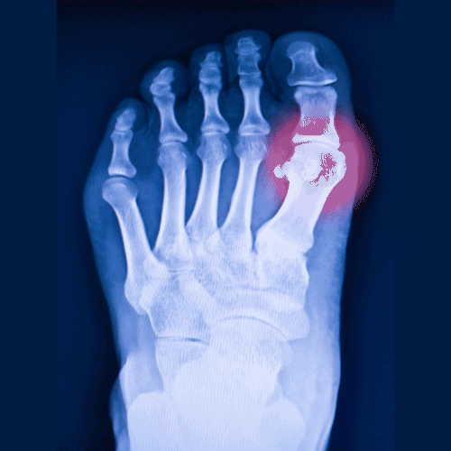 Toe X Ray